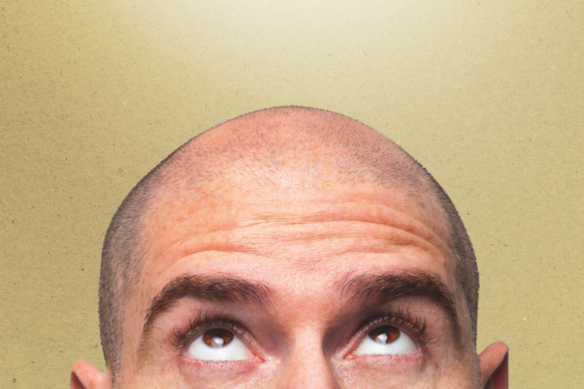 Scores of Men Are Travelling to Istanbul for Hair Transplants. Is It Worth It?