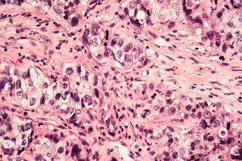 Pink breast cancer cells under a microscope.